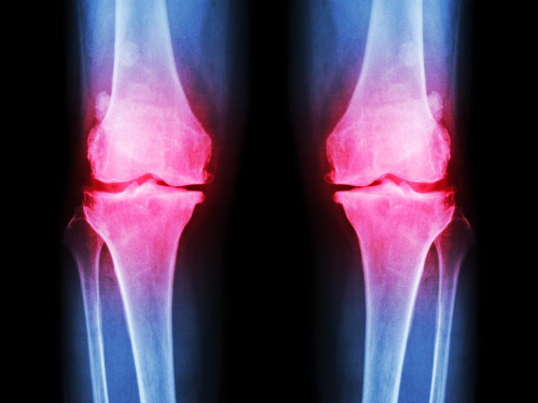 En Que Lugar De España Se Vive Mejor Con Artrosis eddywarman.tv