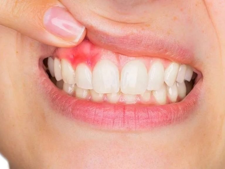 Alzheimer y salud bucal, Vínculo entre periodontitis y Alzheimer, Infección de encías y enfermedad neurodegenerativa, Bacteria Porphyromonas gingivalis en Alzheimer, Estudio científico sobre Alzheimer y periodontitis, Bacterias en cerebros de pacientes con Alzheimer, Gingipaínas y deterioro cognitivo, Enzimas tóxicas en la enfermedad de Alzheimer, Neurología y enfermedad neurodegenerativa, Salud bucal y demencia, Tratamientos para enfermedad de Alzheimer, Inflamación y Alzheimer, Prevención de Alzheimer y cuidado bucal, Impacto de la periodontitis en la salud cerebral, Mecanismos neurodegenerativos en Alzheimer, Relación entre bacterias y demencia, Infecciones bucales y enfermedad de Alzheimer, Gingipaínas en patogénesis del Alzheimer, Cuidados odontológicos y salud cerebral, Odontología preventiva y Alzheimer.