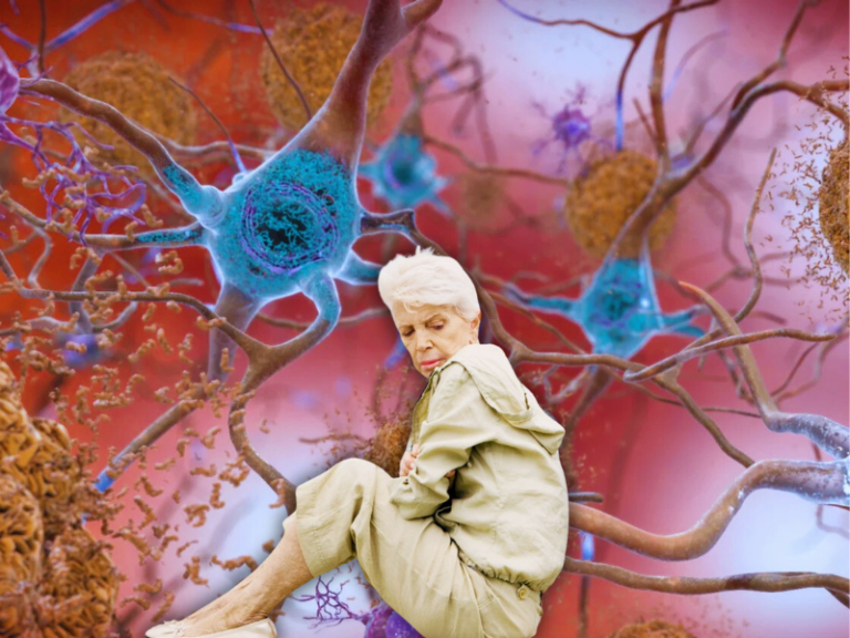 alzheimer